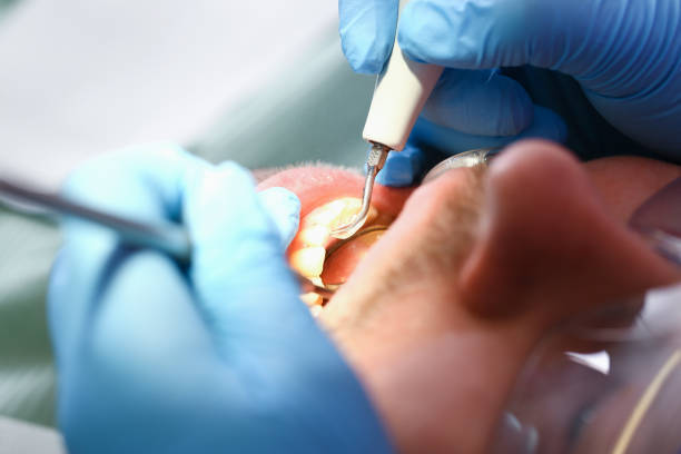 Best Emergency Treatment for Dental Infections or Abscesses in Granite City, IL